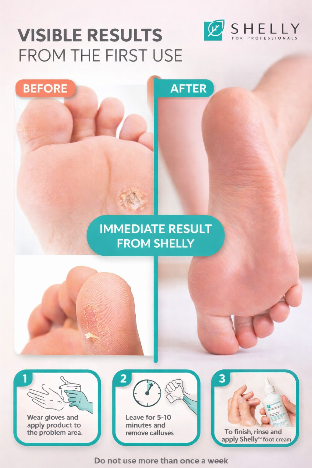 Shelly "Soft Blade" Foot Callus Softening Gel, 100ml