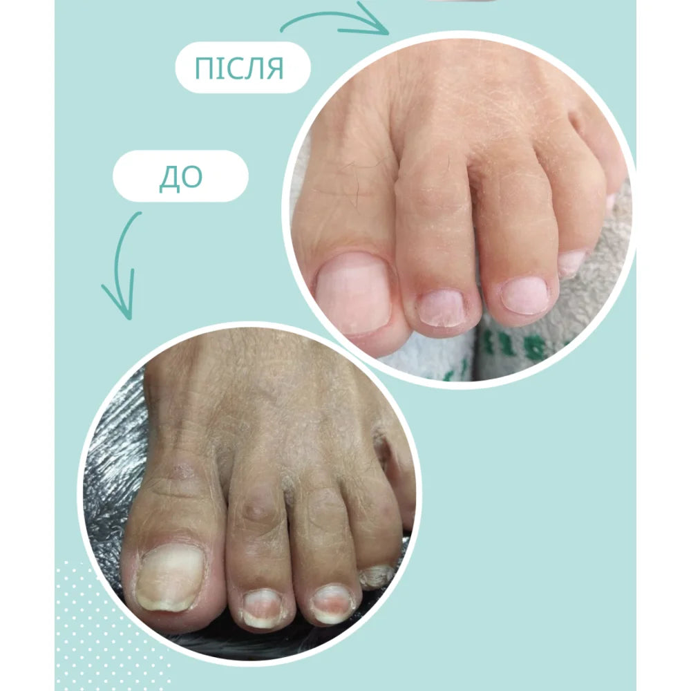 Shelly Stop Onycholysis Oil for Damaged Nails, 30ml