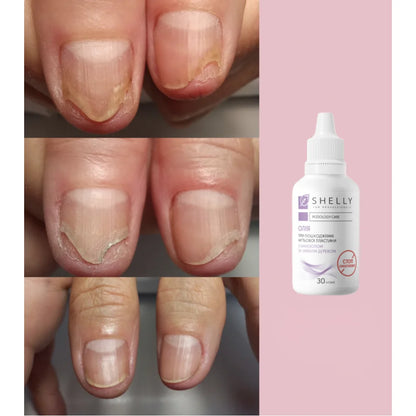 Shelly Stop Onycholysis Oil for Damaged Nails, 30ml