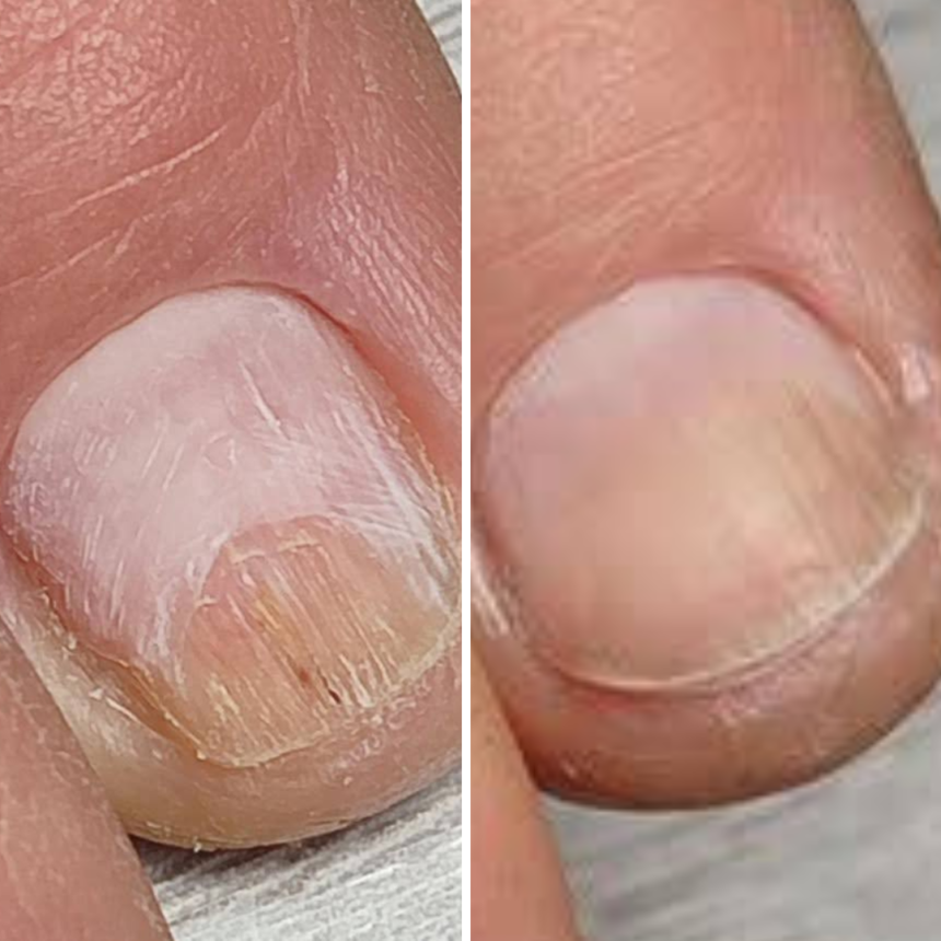 NAILSOFTHEDAY Resultum Onistopix Lotion – Regenerating Nail Lotion, 10ml